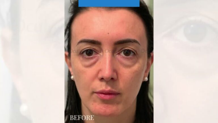 Il sorprendente effetto dell&#8217;acido ialuronico sugli occhi: prima e dopo
